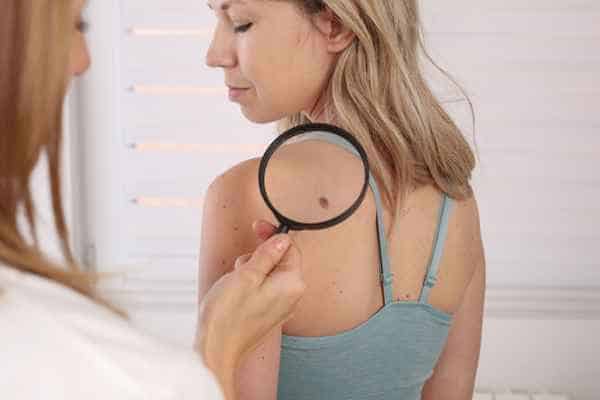 What Are Traditional Skin Lesion Removal Methods Ruislip?