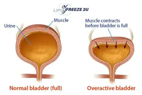diagram of overactive bladder treatment Ruislip