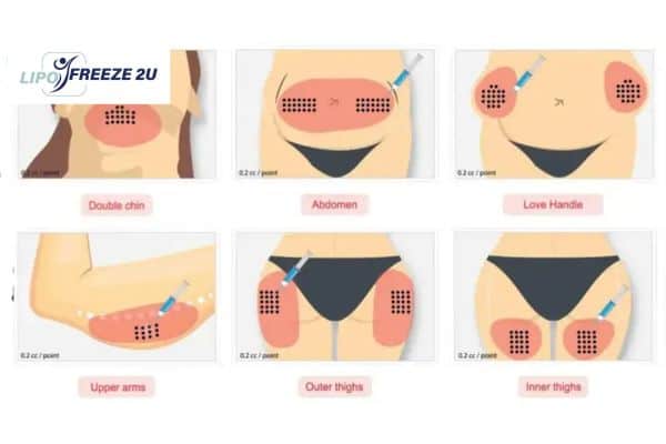 Benefits of Choosing Aqualyx for Fat Reduction Ruislip
