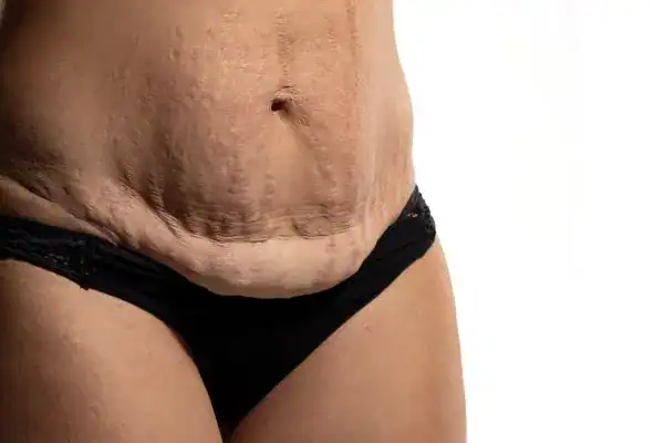 loose skin after weight loss injections Ruislip