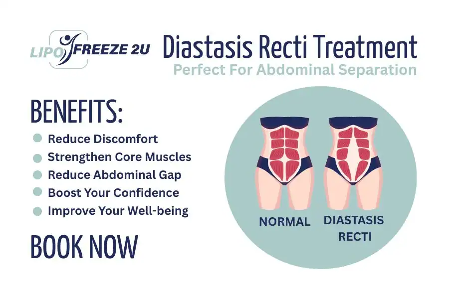 How Long Will It Take to See Improvements in Diastasis Recti Ruislip