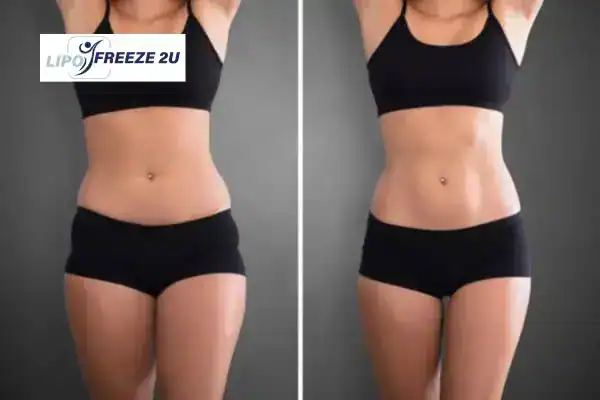 How Can LIPO FREEZE 2U Support Your Post-Pregnancy Body Recovery Ruislip?