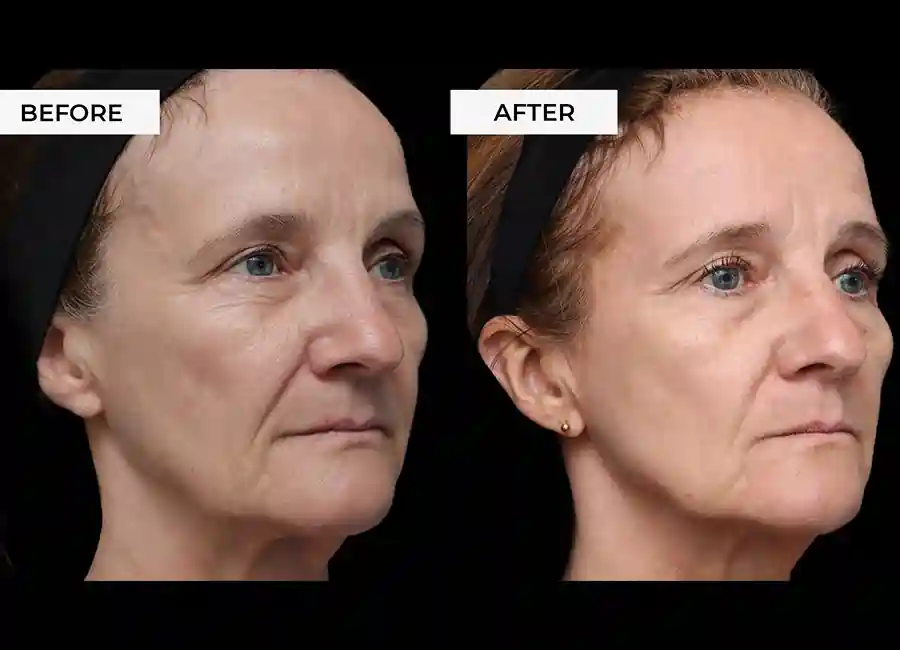 How Many RF Microneedling Sessions Will You Need to See a Difference Ruislip?