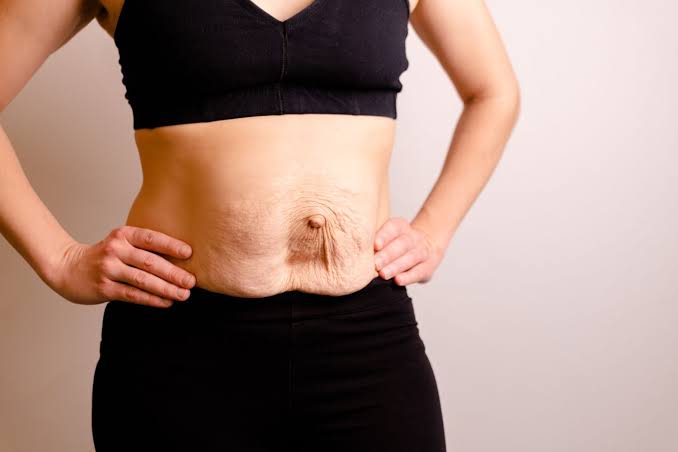 Is Surgery Really the Only Way to Repair Diastasis Recti Ruislip?