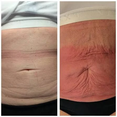 How Does RF Microneedling Improve Crepey, Thin and Uneven Skin Texture Ruislip?