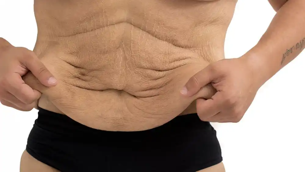 Why Does Weight Loss Medication Leave Some People With Loose or Sagging Skin Ruislip?